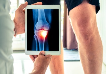 Osteoarthritis Billing