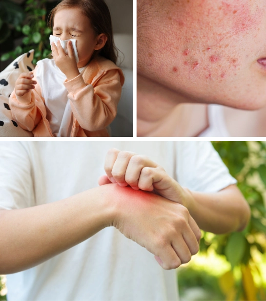 updated algergy and immunication